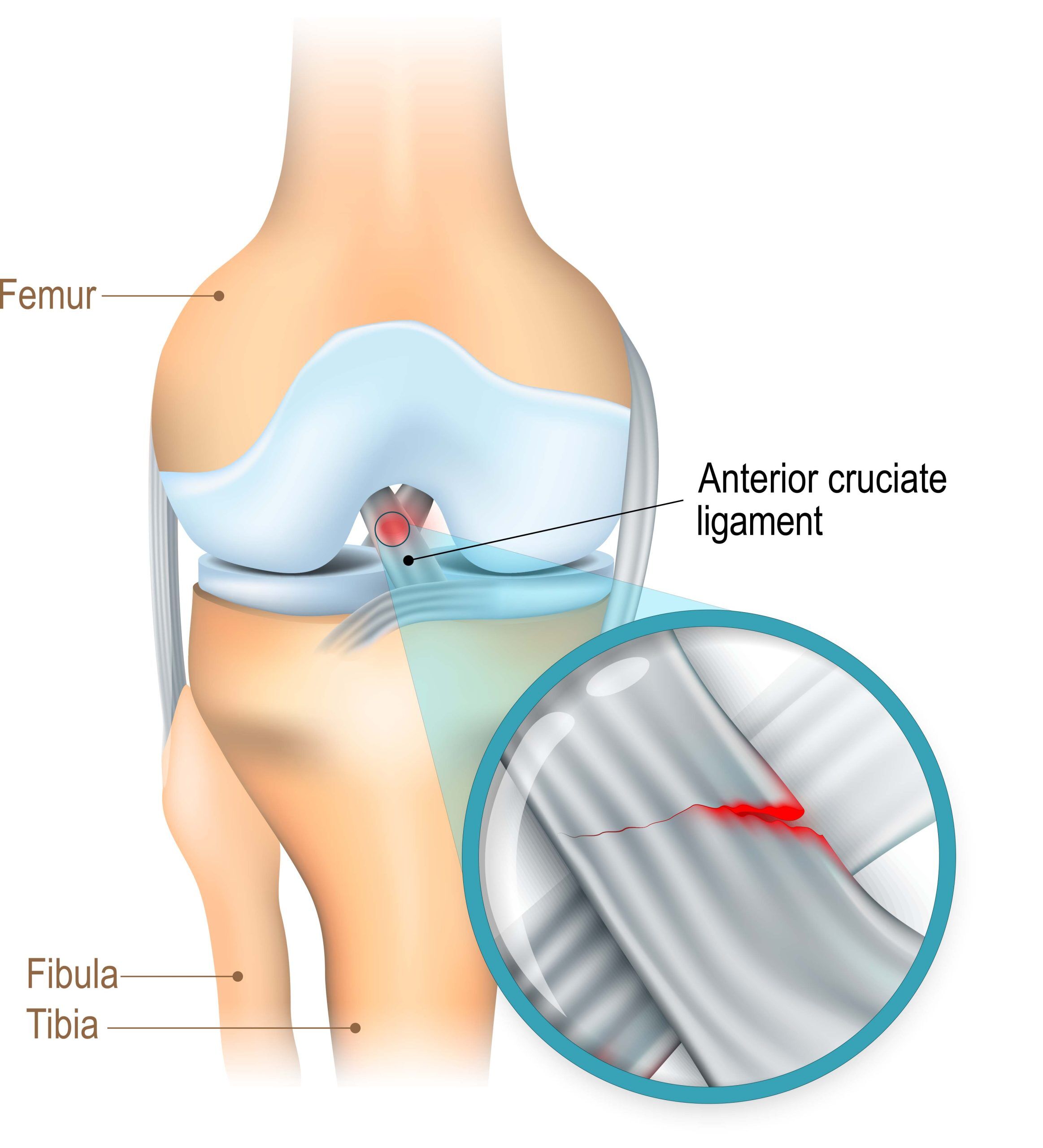 Ligament Joint Injuries & ACL Reconstruction